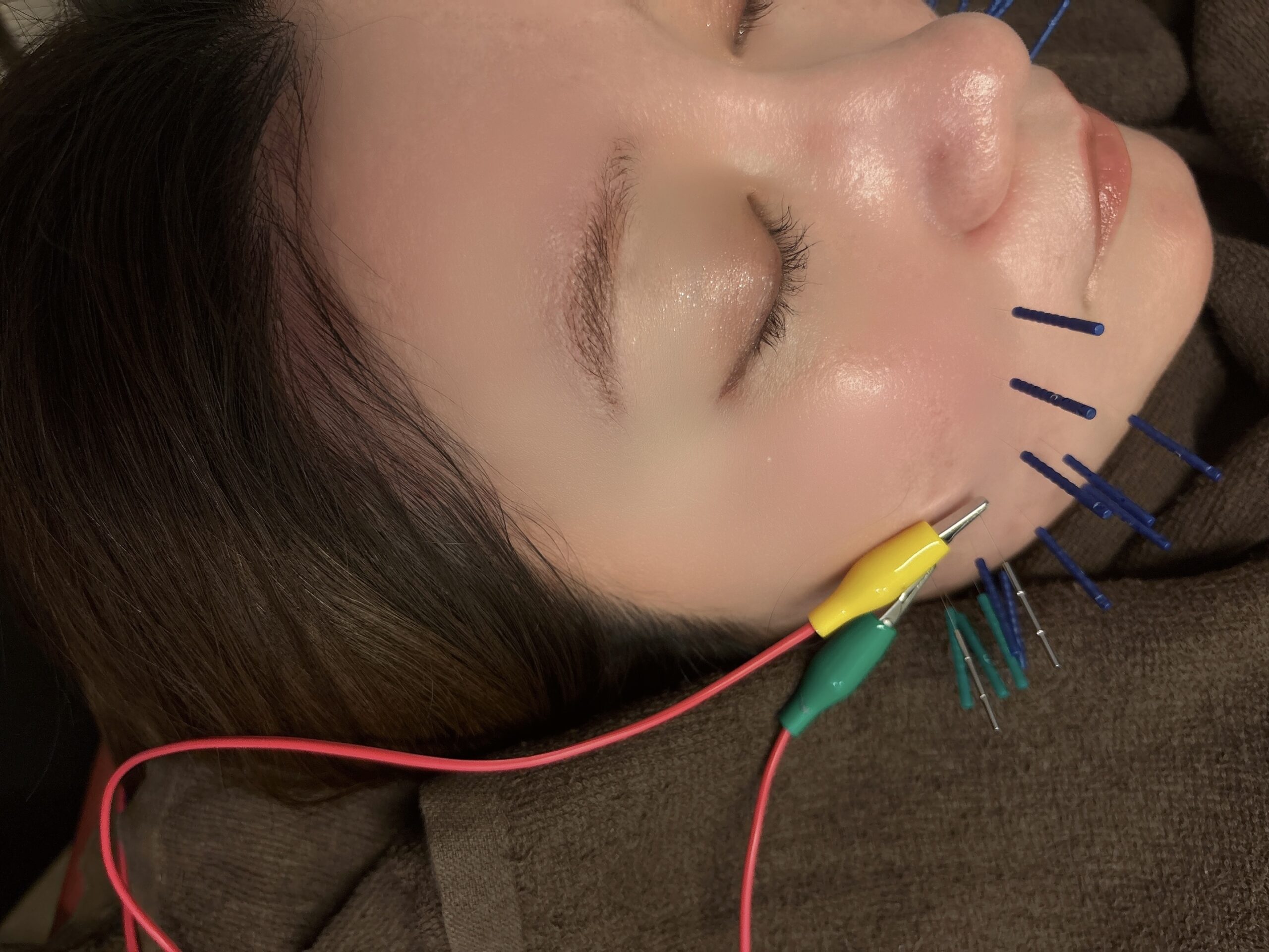 美容鍼もオプションで対応